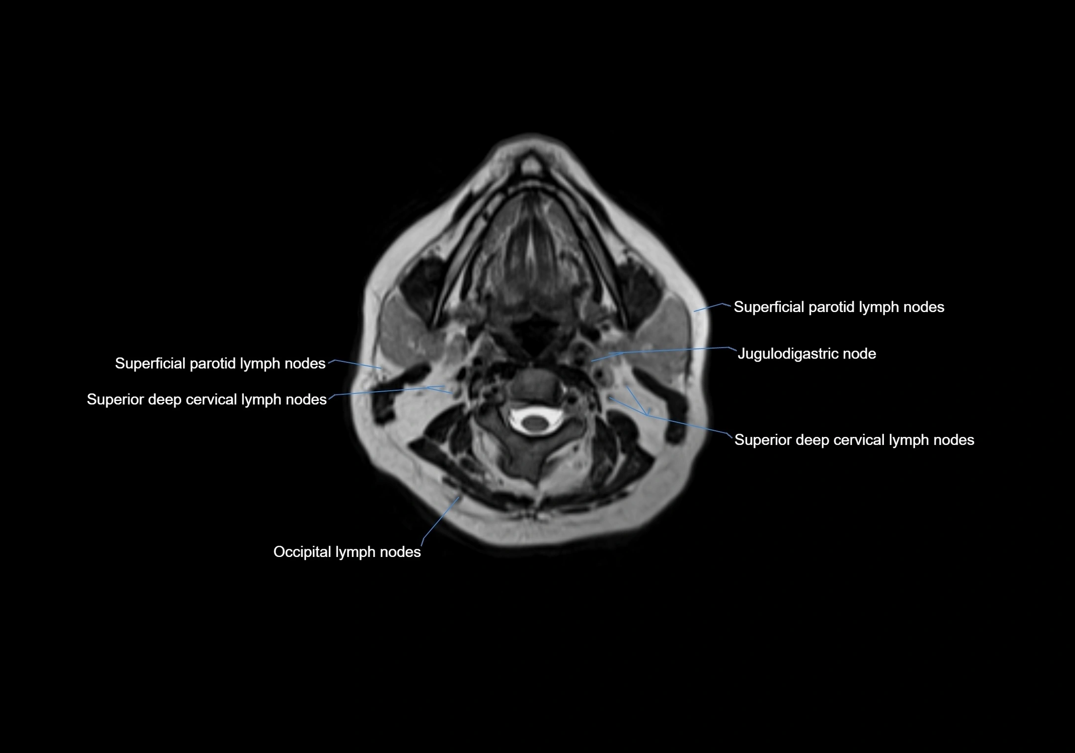 Neck axial  lymph node cross sectional MRI anatomy 3T MRI  image-img-00001-00045.webp